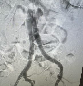 image of open heart artery