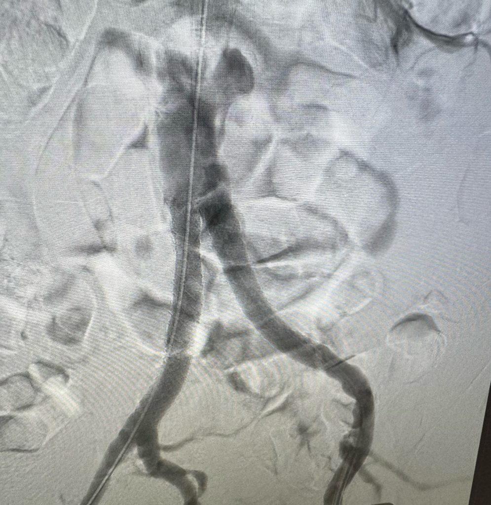 image of open heart artery after procedure