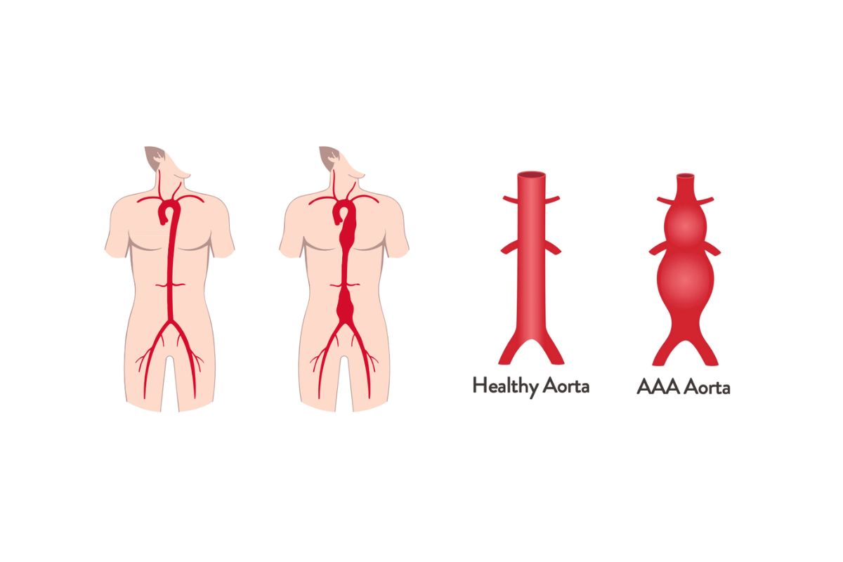 Abdominal Aortic Aneurysm (AAA) – Advanced Aneurysm Detection & Minimally Invasive Treatment