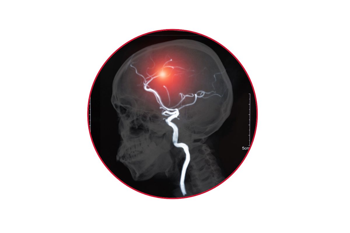 Carotid Artery Disease (CAD)-Advanced Stroke Prevention & Vascular Care